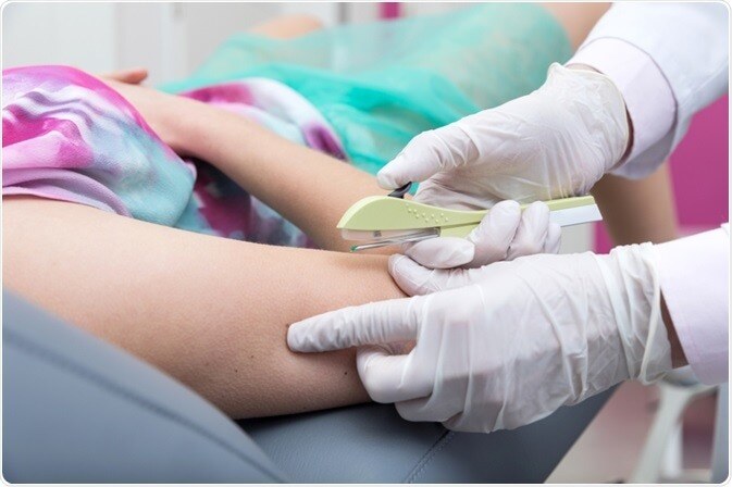 Canela na vanguarda: implante contraceptivo é ofertado pelo Município desde 2020; aquisição via SUS ampliará investimentos na Saúde